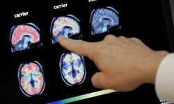 Alzheimer hastalığı için yeni geliştirilen 'lecanemab' adlı ilaca ilk onay