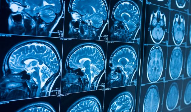 Kanada'da görülen 'gizemli' beyin hastalığı araştırılıyor
