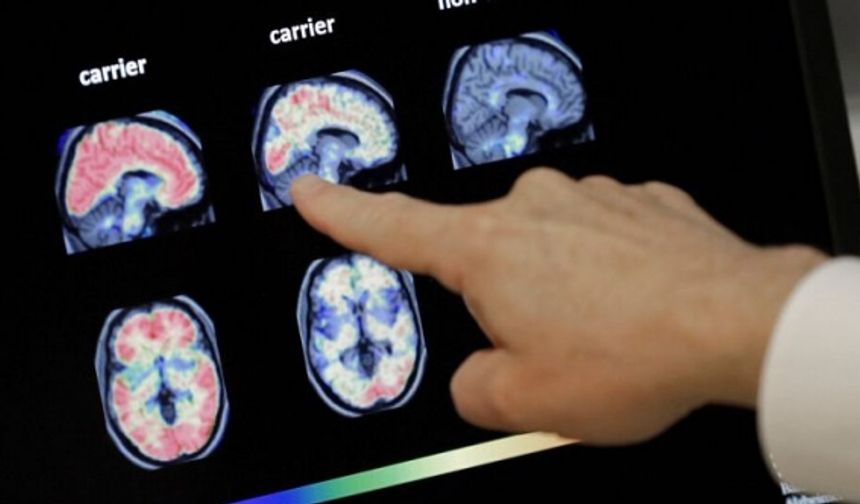 Alzheimer hastalığı için yeni geliştirilen 'lecanemab' adlı ilaca ilk onay